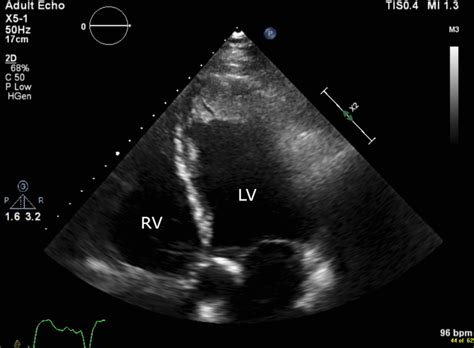 lv thrombus echo|what is an apical thrombus.